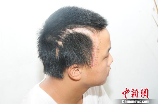14歲男孩車(chē)禍重傷 因無(wú)力支付高額手術(shù)費(fèi)父拒認(rèn)子